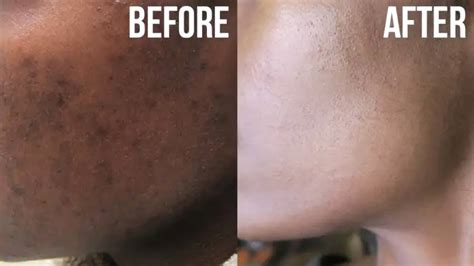 Face Pigmentation Treatment At Home Doctor Heck