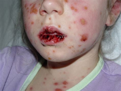 Residents and fellows contest rules | international ophthalmologists contest rules. Stevens-Johnson Syndrome - Dermatology - Medbullets Step 2/3