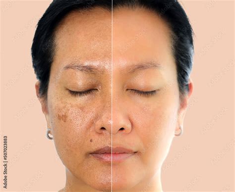 Fototapeta Kuchenna Image Before And After Spot Melasma Pigmentation