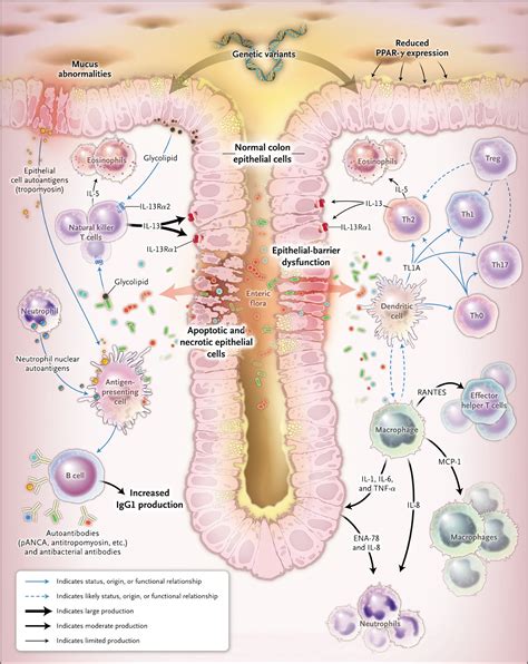 Ulcerative Colitis Nejm