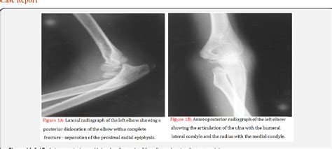 Figure From Proximal Radio Ulnar Translocation Associated With Posterior Dislocation Of The