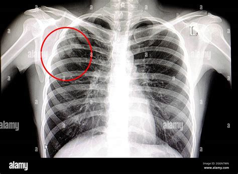 Xray Film Of A Patient With Pulmonary Tuberculosis Stock Photo Alamy