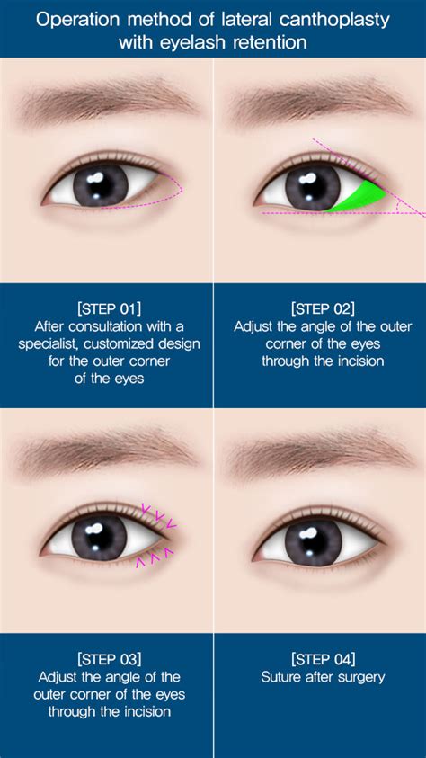 Lateral Canthoplasty With Eyelash Retention Eye Angle Reshaping