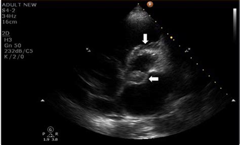 Ruptured Mitral Aortic Intervalvular Fibrosa Aneurysm With Flail Aortic