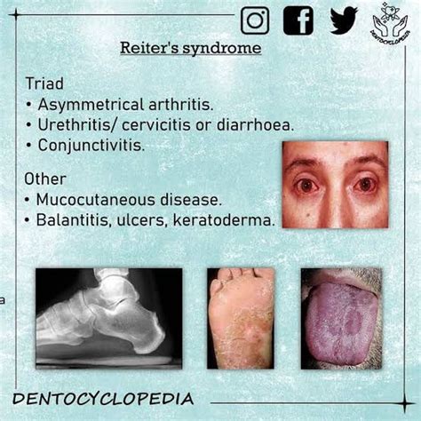 Causes Of Reiters Syndrome MEDizzy