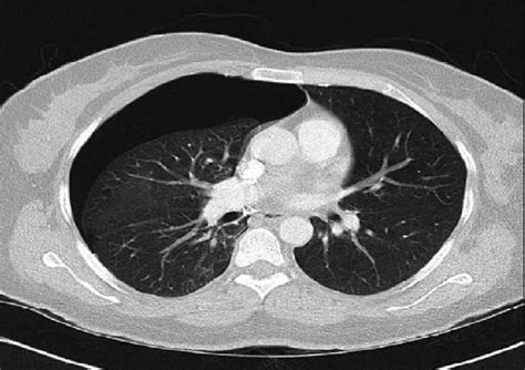 Chest Ct Revealed Right Sided Pneumothorax Without Any Parenchymal