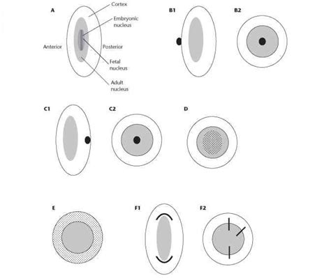 Cataracts Inherited Diseases Americorps Health