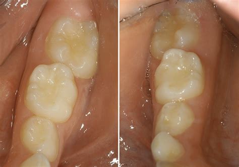 6 Year Old Molars And How To Help During Their Eruption Kiddies
