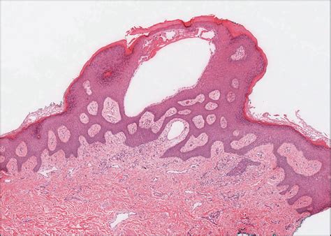 Vesicular Lesions On The Vulva—quiz Case Jama Dermatology The Jama