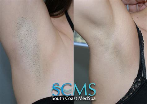 Laser hair removal also has one significant limitation. photo