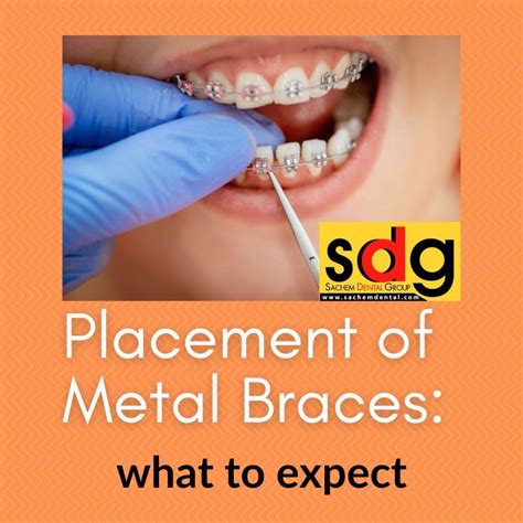 The Placement Of Metal Braces What To Expect