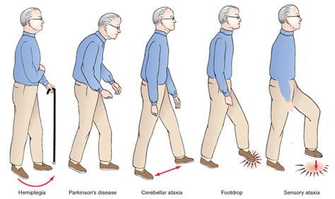 The Gait System How Gait Recognition Works And Physiotherapy