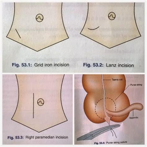 These pictures of this page are about:appendectomy incision. Appendicectomy | Medik Bloglist