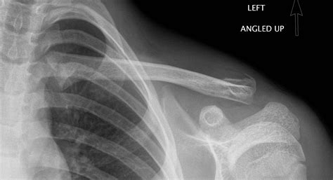 Fractures Clavicle