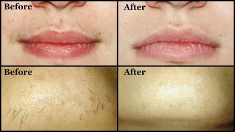 Remove Unwanted Upper Lip Hair And Chin Hair By Yourself Easily At Home