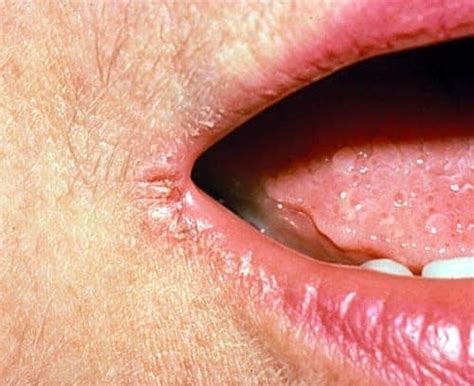 Angular Cheilitis Treatment Causes How To Get Rid Of It