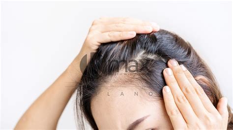 Female Alopecia Causes And Treatments Explained By The Trichologist