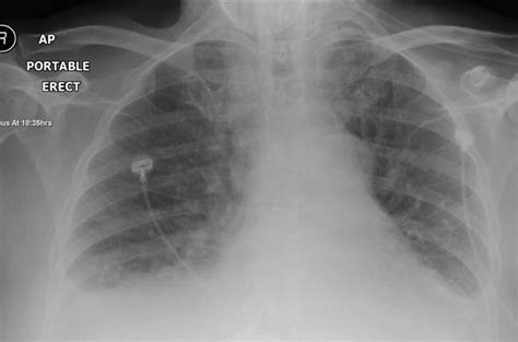 Cardiogenic Pulmonary Oedema Rcemlearning