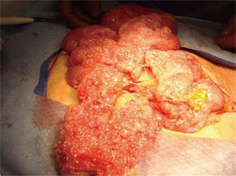 Benign multicystic mesothelioma (also referred to as peritoneal multicystic mesothelioma) is a benign form of peritoneal mesothelioma. Benign multicystic peritoneal mesothelioma: A rare case ...