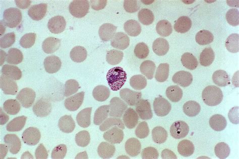 Kostenlose Bild rot Blut Zellen Infektion Plasmodium vivax reif trophozoite Bühne