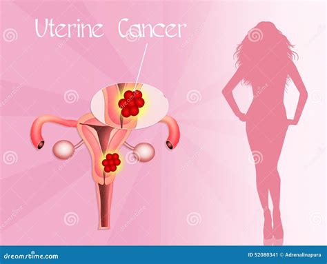 Uterine Cancer Illustration And Micrograph Royalty Free Cartoon Cartoondealer Com