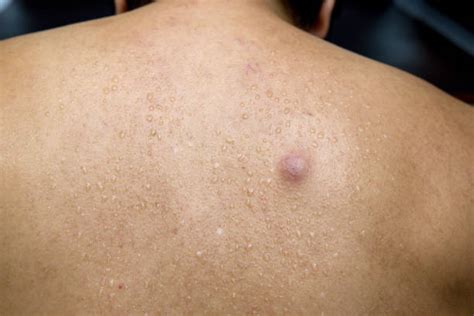 Acne Back Scar Pimple Stock Photos Pictures And Royalty Free Images Istock