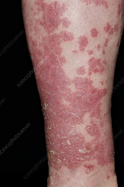 Psoriasis On The Leg Stock Image C0168233 Science Photo Library