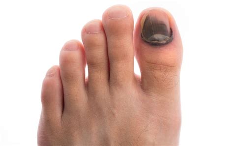 Why Runners Toenails Fall Off 4 Helpful Tips To Prevent It