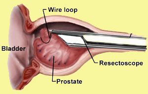Transurethral Resection Of Prostate Turp Chin Chong Min Urology Robotic Surgery Centre