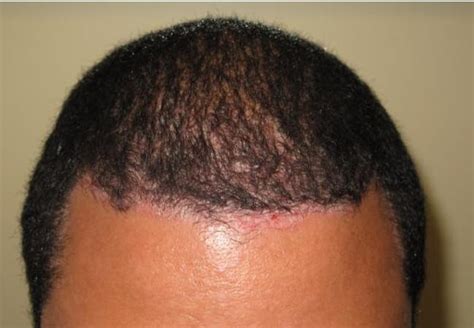 What Is Scalp Psoriasis National Psoriasis Foundation
