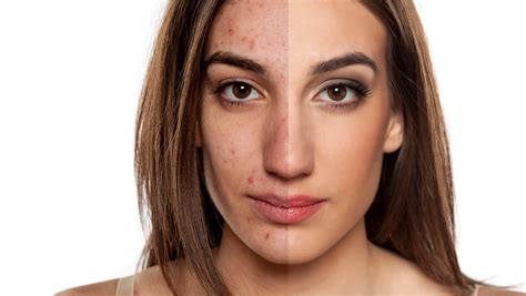 Home Remedies For Uneven Skin Tone Richmond Hill Cosmetic Clinic