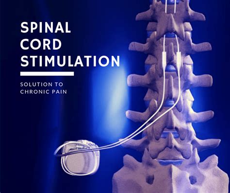 Spinal Cord Stimulation Amara Pain And Spine Management