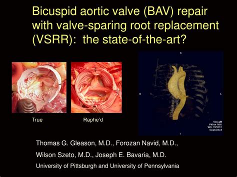 Ppt Bicuspid Aortic Valve Bav Repair With Valve Sparing Root