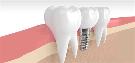 What Is Dental Implants And Who Can Do Dental Implants Dental News