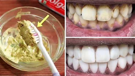 See How To Get Very White Teeth In Just 2 Minutes Magical Teeth