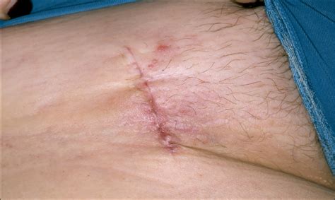 Sentinel Lymph Node Biopsy For Melanoma An Important Risk