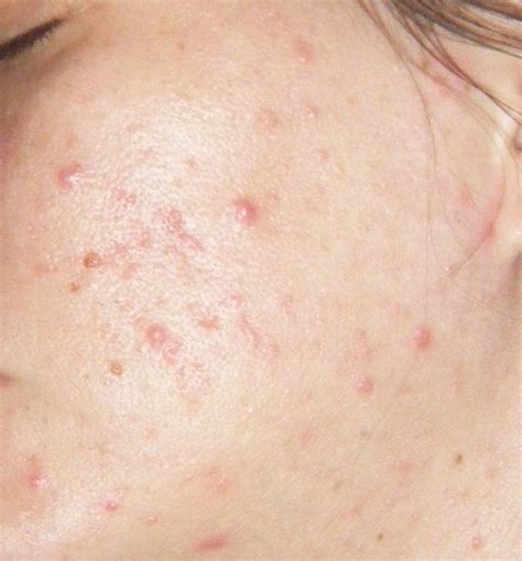 Lymph Nodes General Acne Discussion By Frustratedgirl
