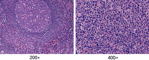 Morphology Of Hande Stained Dlbcl And Reactive Lymph Node Hyperplasia