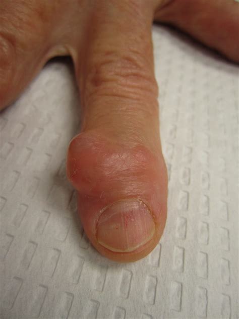 Pictures Of Mucous Cyst In Finger Raleigh Hand To Shoulder Center
