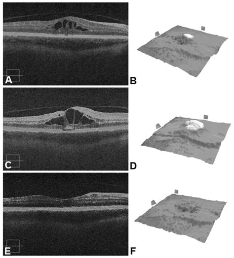 Optical Coherence Tomography OCT And Response Of Cystoid Macular Download Scientific Diagram