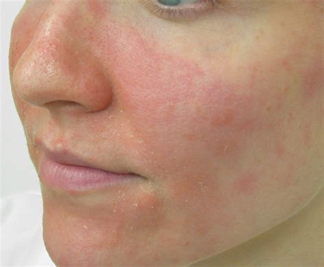 Dermatologist Singapore Eczema Itch Rashes