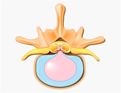 The Difference Between Bulging Discs And Herniated Discs