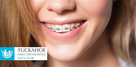 How Long Does Orthodontic Treatment Typically Last