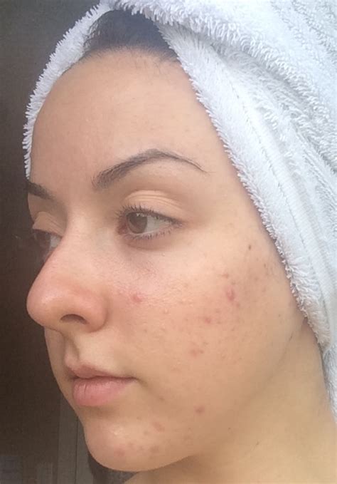 My Skins Journey Week 36 Banish Acne Scars
