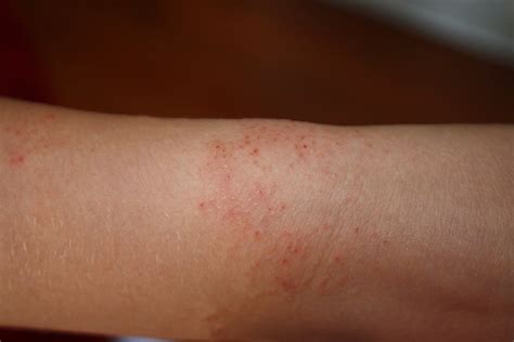Mysterious Rash Pictures Photos