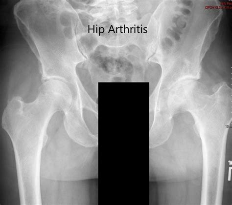 Total Hip Arthroplasty For Developmental Dysplasia Of The Hip 4ba