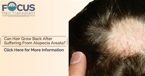 I have been having severe seb.dermatitis and hair loss for two years. Can hair grow back after suffering from Alopecia Areata?
