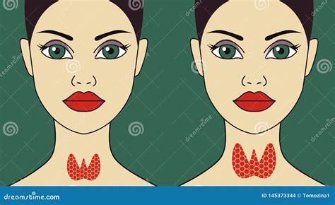 Normal And Enlarged Thyroid Gland Vector Illustration Cartoondealer