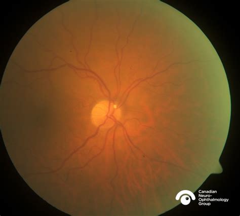 0103 Retinal Embolus With Old Branch Retinal Arterial