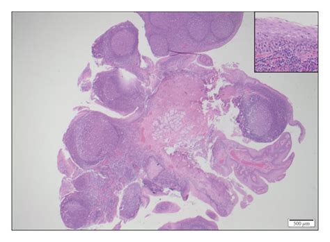 Histology Of Polyps From Base Of Tongue The Lamina Propria Contains